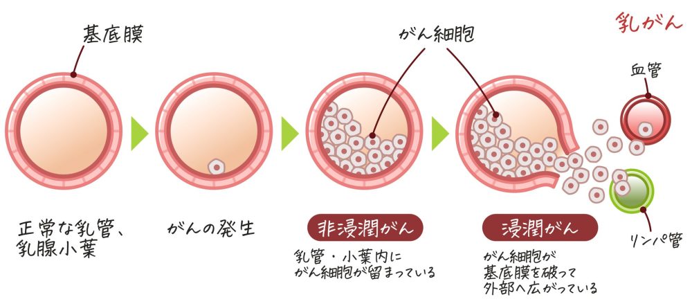 非 浸潤 癌 なのに 全 摘